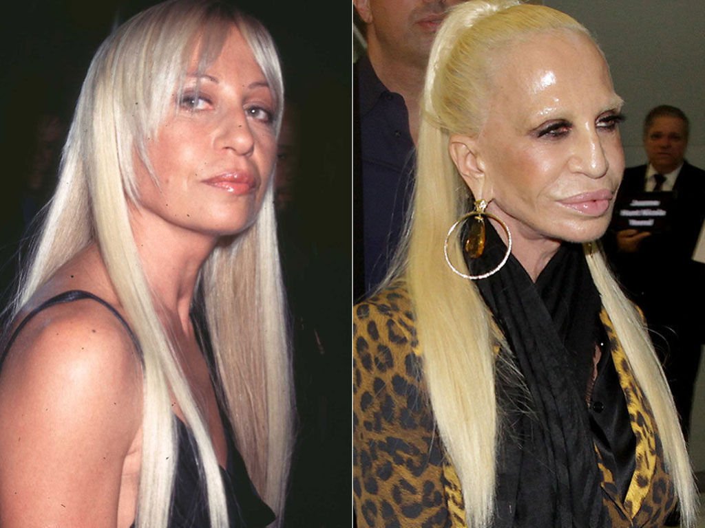 20-worst-cases-of-celebrity-plastic-surgery-gone-wrong-1 plastic-surgery-fact-8w