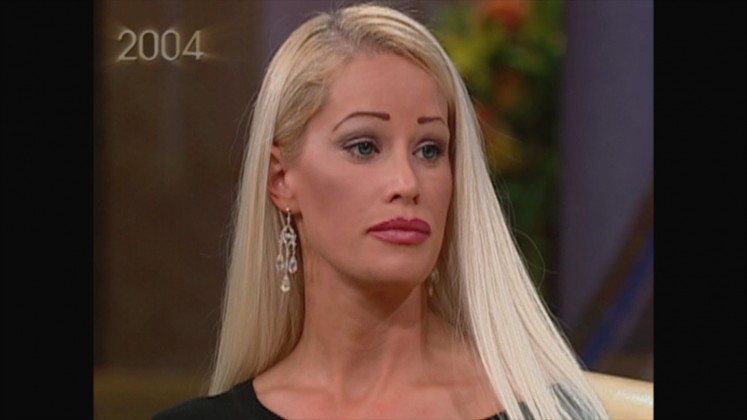 plastic-surgery-before-and-after-145