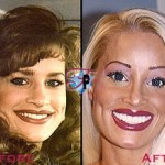 plastic-surgery-before-and-after-145