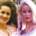 plastic-surgery-before-and-after-145