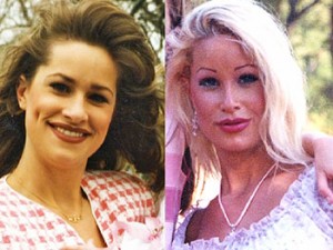 plastic-surgery-before-and-after-145