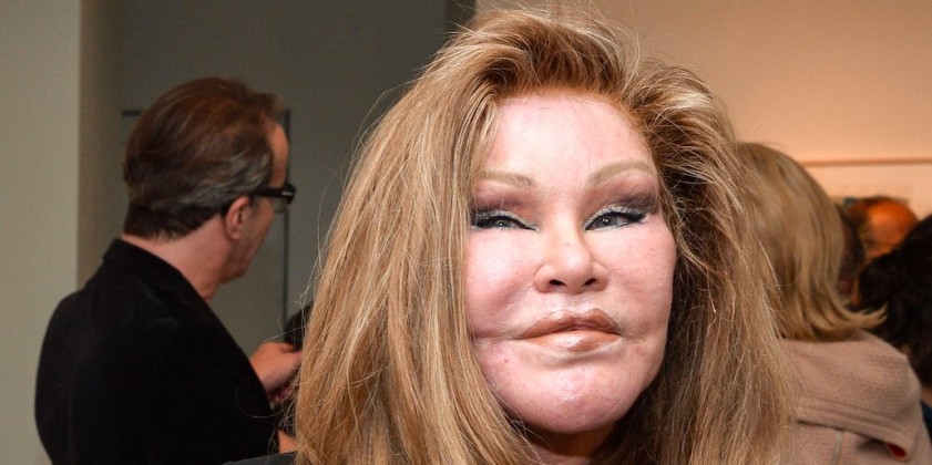 plastic-surgery-gone-wrong-1-78