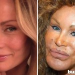 plastic-surgery-gone-wrong-1-78