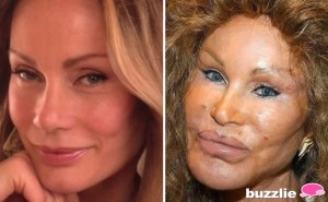 plastic-surgery-gone-wrong-1-78