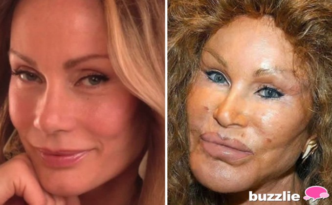plastic-surgery-gone-wrong-1-78