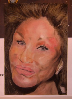 plastic-surgery-gone-wrong-1-78